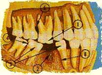 shifting and tilting teeth