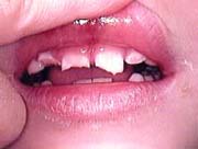 teeth fractured in an accident