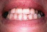 restored front teeth