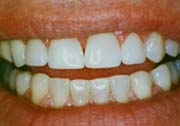 spacing between teeth closed by bonding