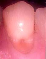 the tooth with erosion