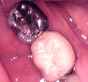 an esthetic procelain crown on a molar