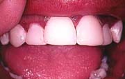 restored teeth by bonding