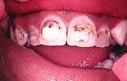 discolored and decayed teeth