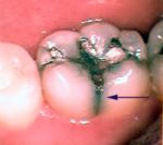 a crack on the side of the tooth