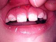 teeth repaired by bonding