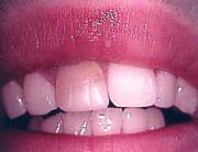 discolored front tooth