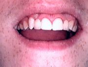 tooth restored by bonded bridge
