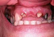 damaged front teeth