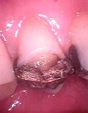 fractured tooth