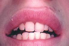restored central incisor
