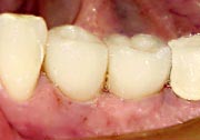 teeth with crowns cemented