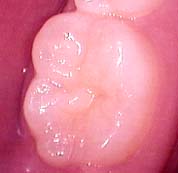 tooth before sealant