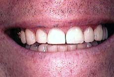 teeth repaired with porcelain veeners