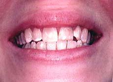 discolored teeth and a rotated incisor